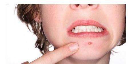 嘴巴下面长痘痘的原因有哪些？