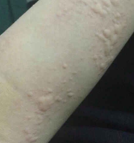 福州华研皮肤科解析：荨麻疹图片和症状